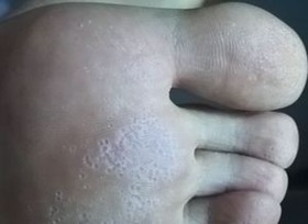 足癣 足癣